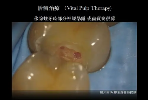 活髓治療
