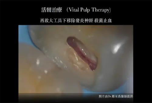 活髓治療