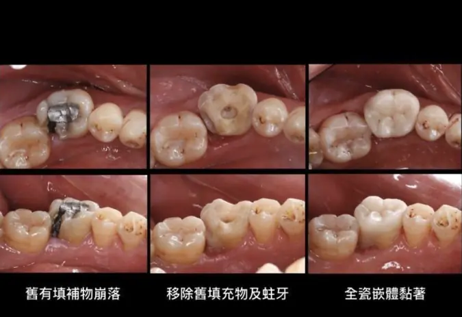陶瓷嵌體/3D齒雕