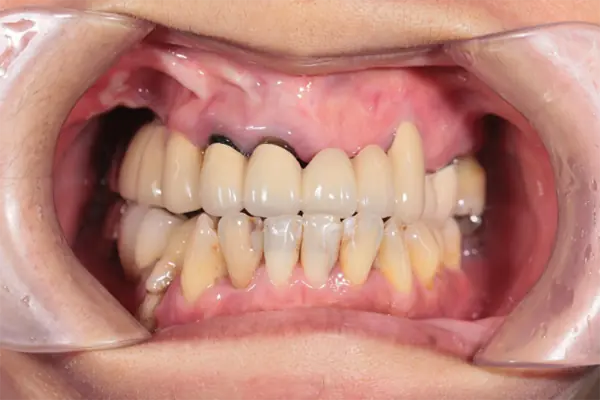 All on 4 / All on 6 全口重建