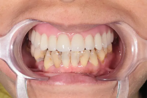 All on 4 / All on 6 全口重建