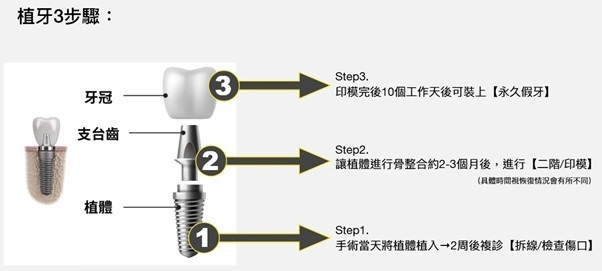植牙重建｜日安牙醫診所 — 重拾自信微笑的最佳選擇