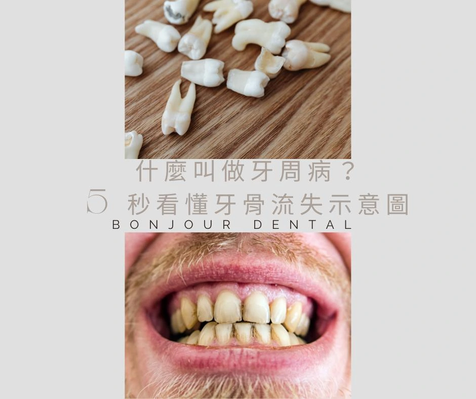🦷 牙周病不是老人病！現在 20–30 歲也很常見