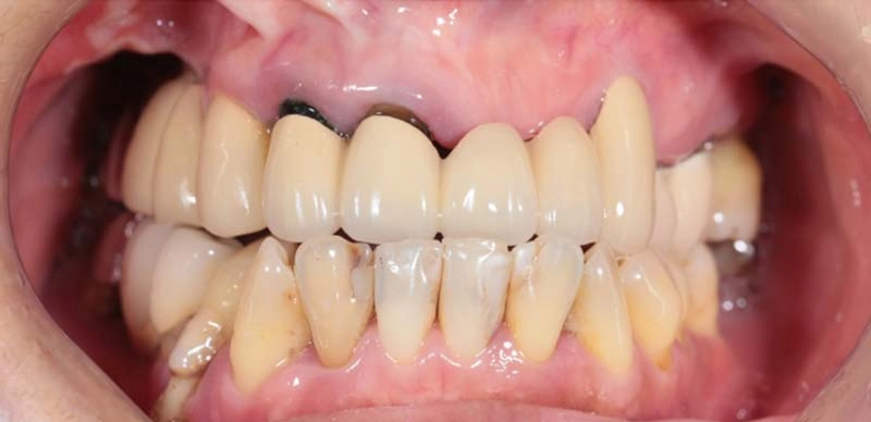 All ON 4/6一日全口重建