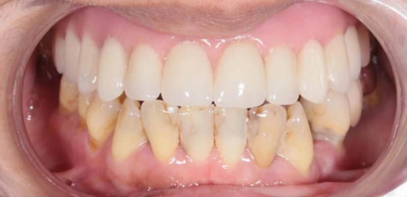 All ON 4/6一日全口重建