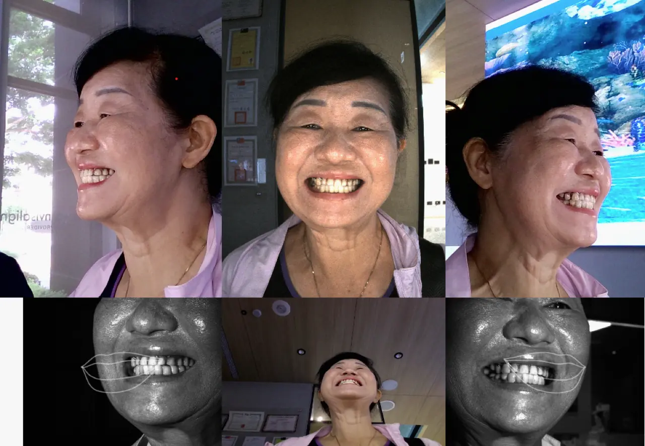 Straumann® Pro Arch Straumann® Pro Arch 治療案例術後示意