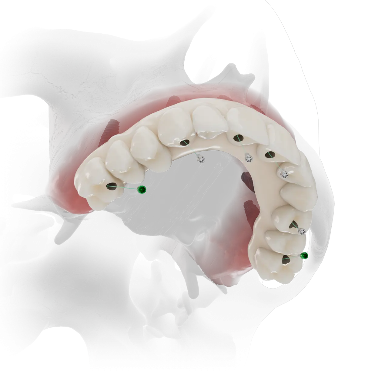 Straumann® Pro Arch Straumann® Pro Arch