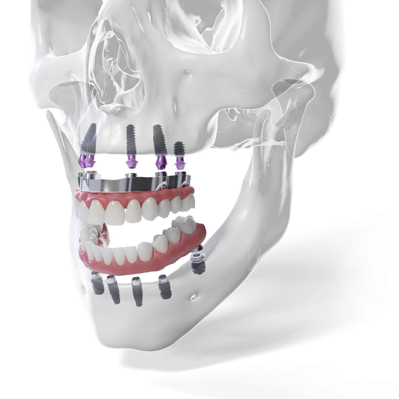 Straumann® Pro Arch Straumann® Pro Arch