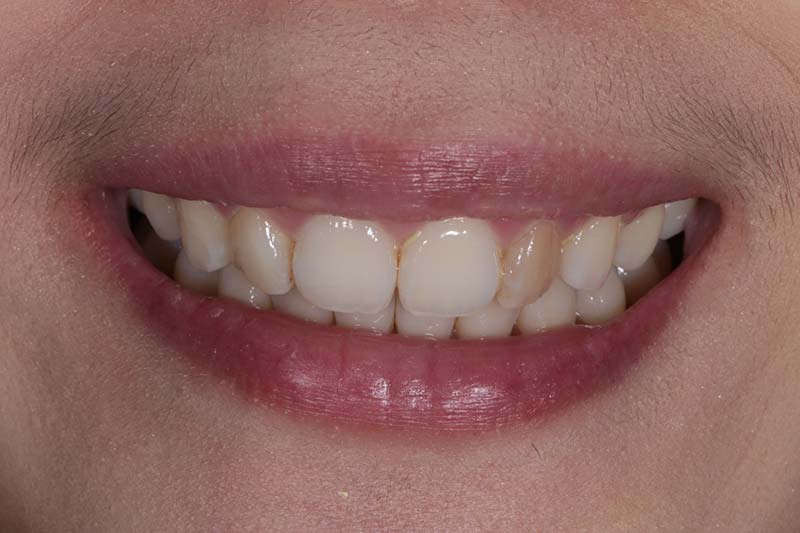 全瓷牙冠 全瓷牙冠