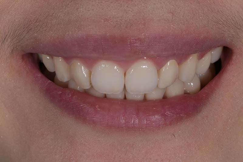 全瓷牙冠 全瓷牙冠