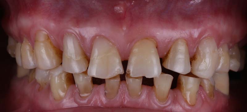 全瓷貼片美學 全瓷貼片美學