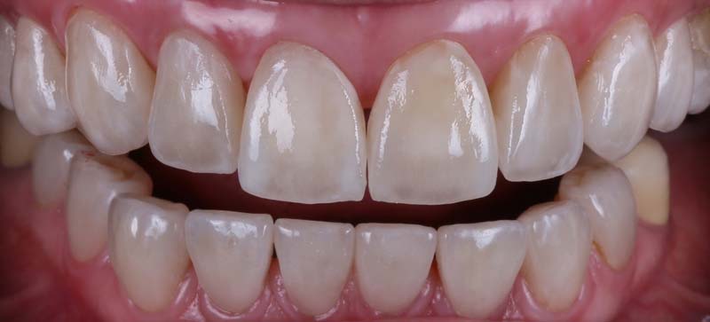 全瓷貼片美學 全瓷貼片美學