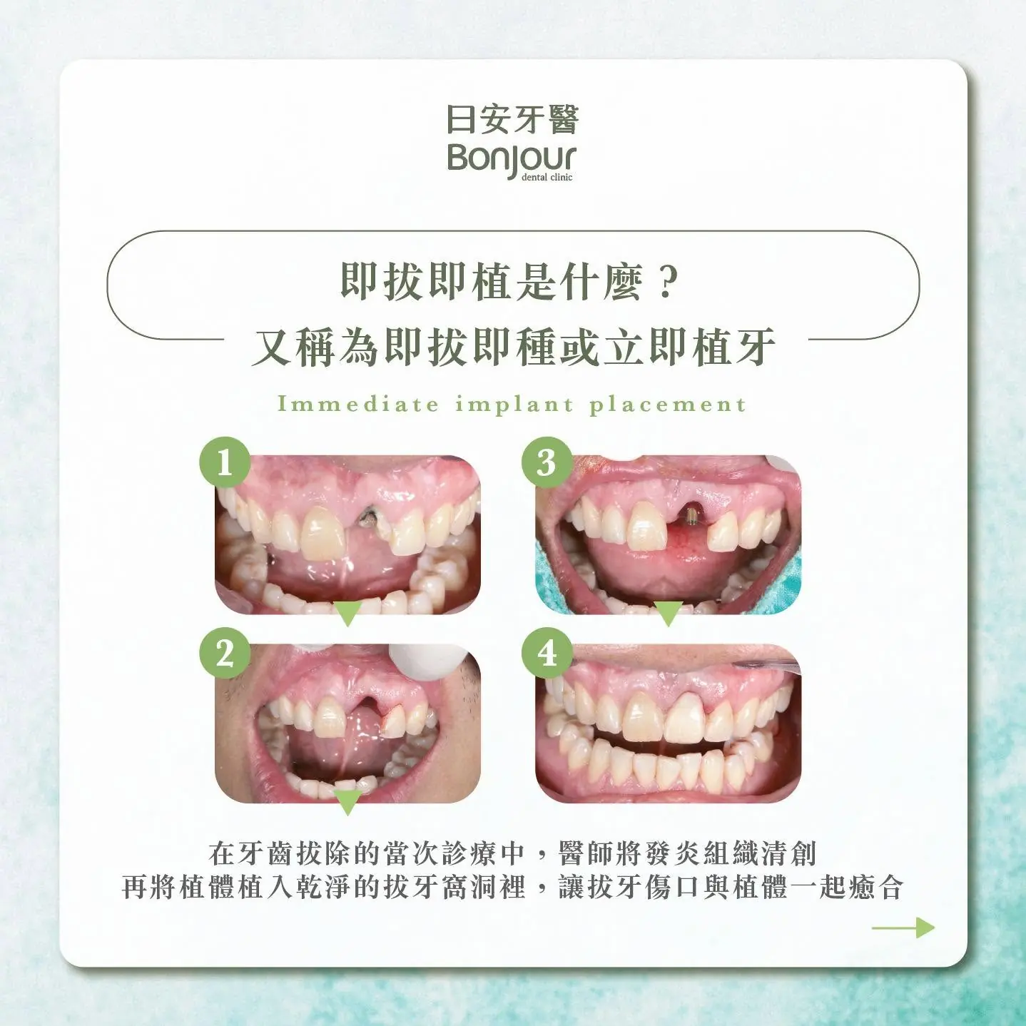 即拔即種植牙