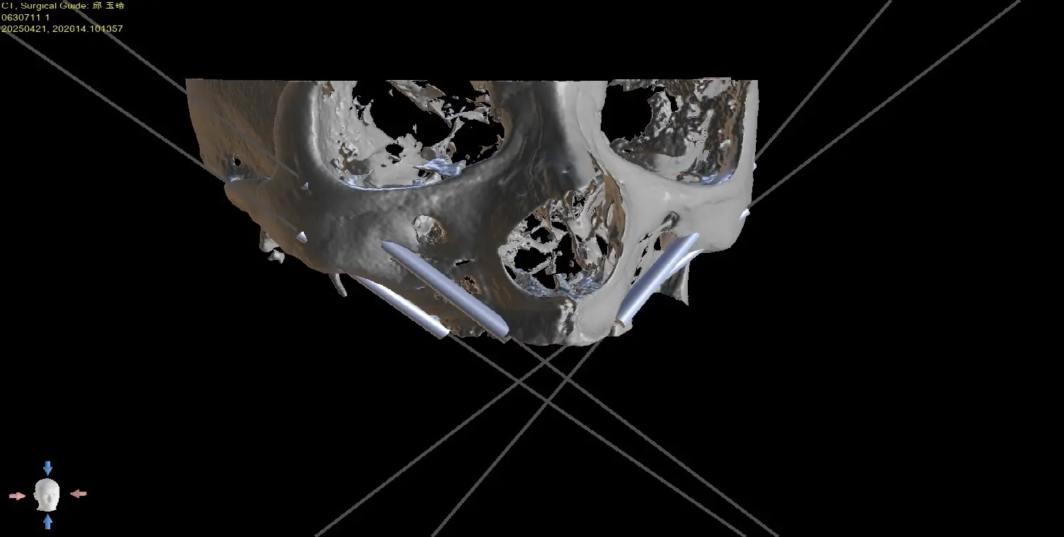 顴骨植牙|Zygomatic Implant 顴骨植牙|Zygomatic Implant